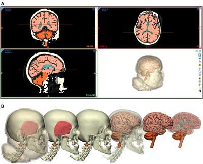 Development and Validation of a Novel Methodological Pipeline to Integrate Neuroimaging and Photogrammetry for Immersive 3D Cadaveric Neurosurgical Simulation